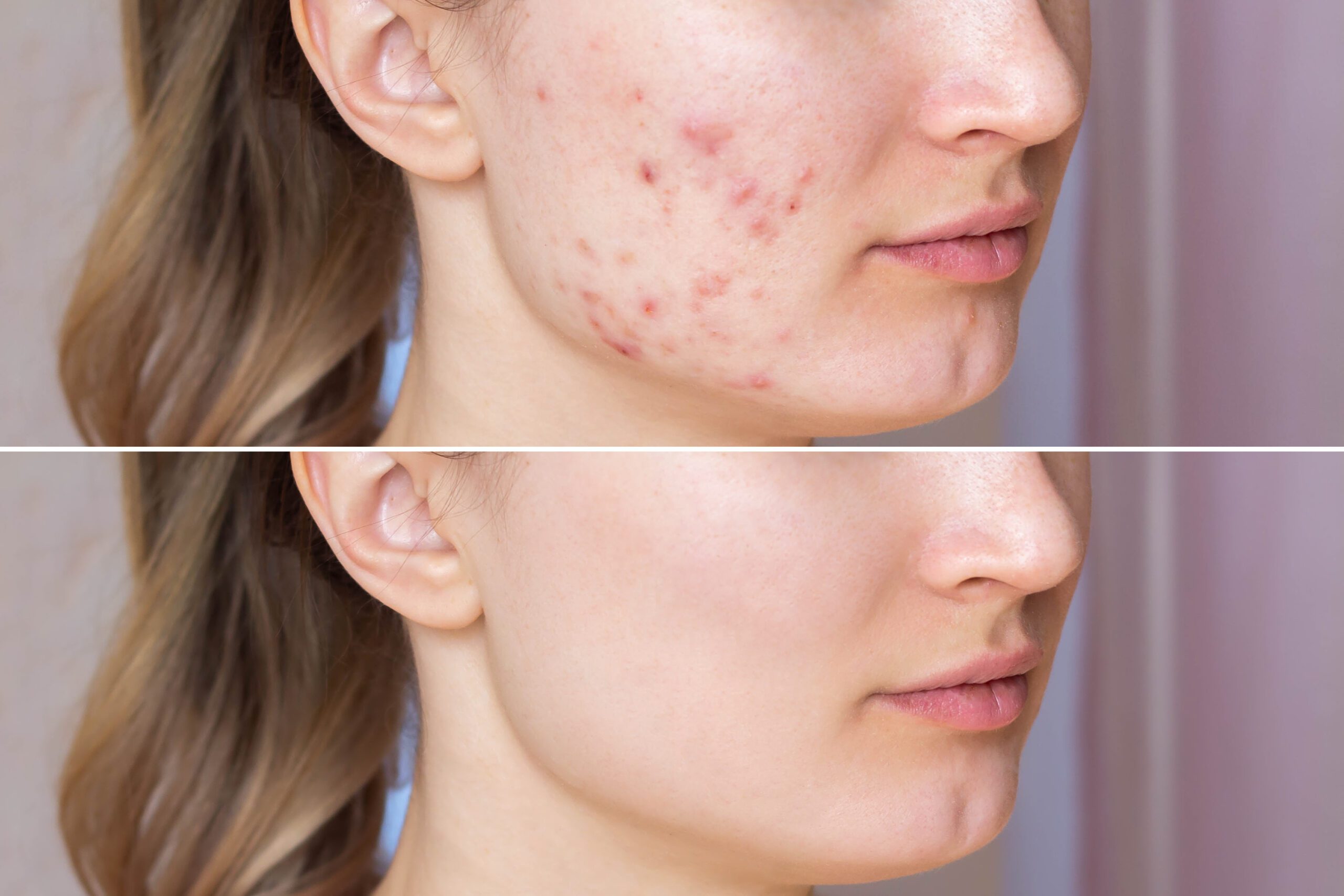 acne and pore treatment course